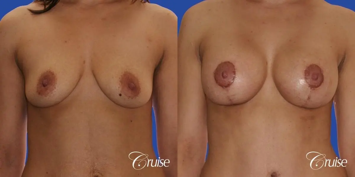 best scars for breast lift anchor saline in Newport Beach, Orange County - Before and After 1