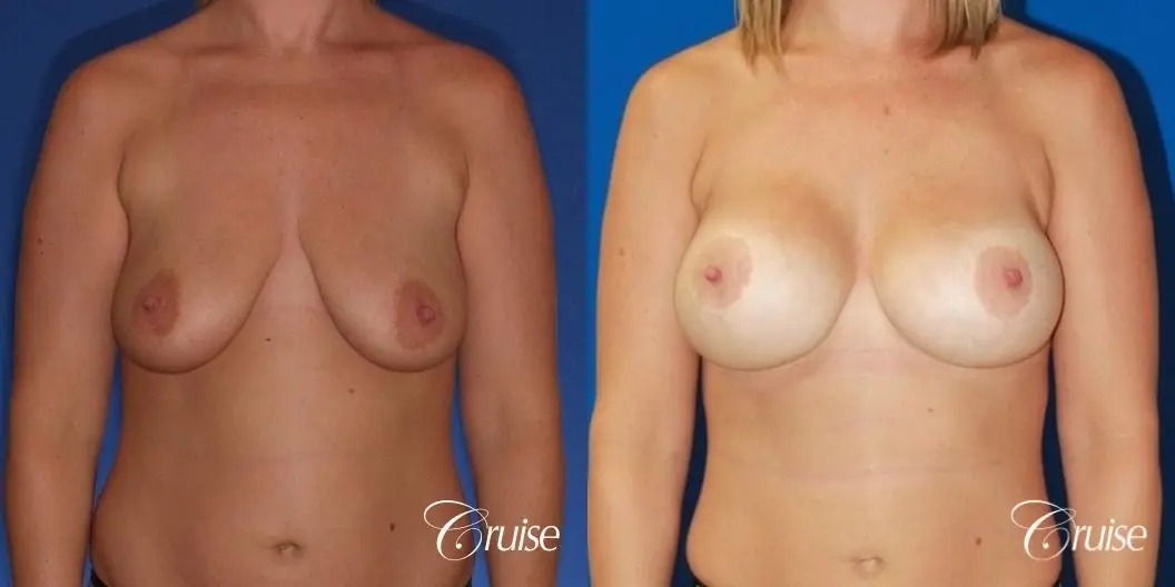 best before and after of breast lift anchor with high profile saline augmentation - Before and After 1