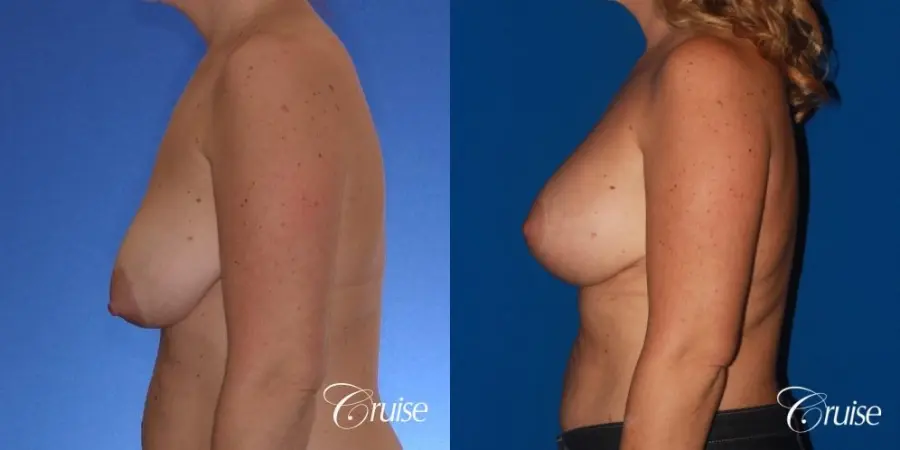breast lift anchor on mature woman 21 - Before and After 2