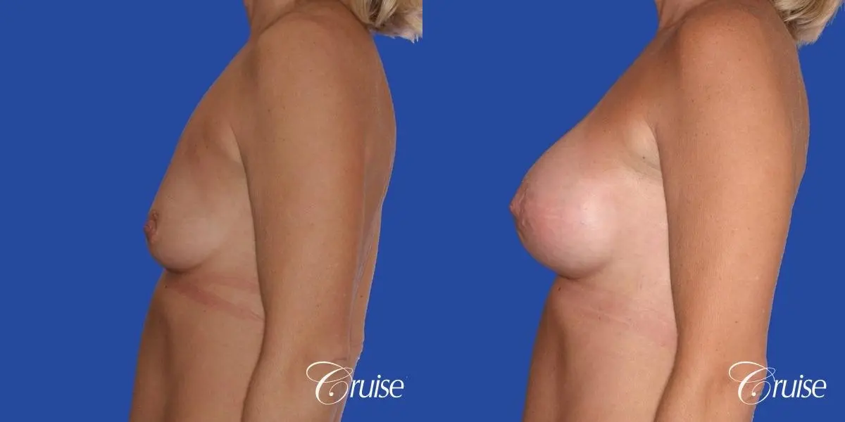 breast lift anchor with silicone implants on adult - Before and After 2