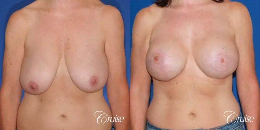 best breast lift anchor with high profile saline implants - Before and After 1