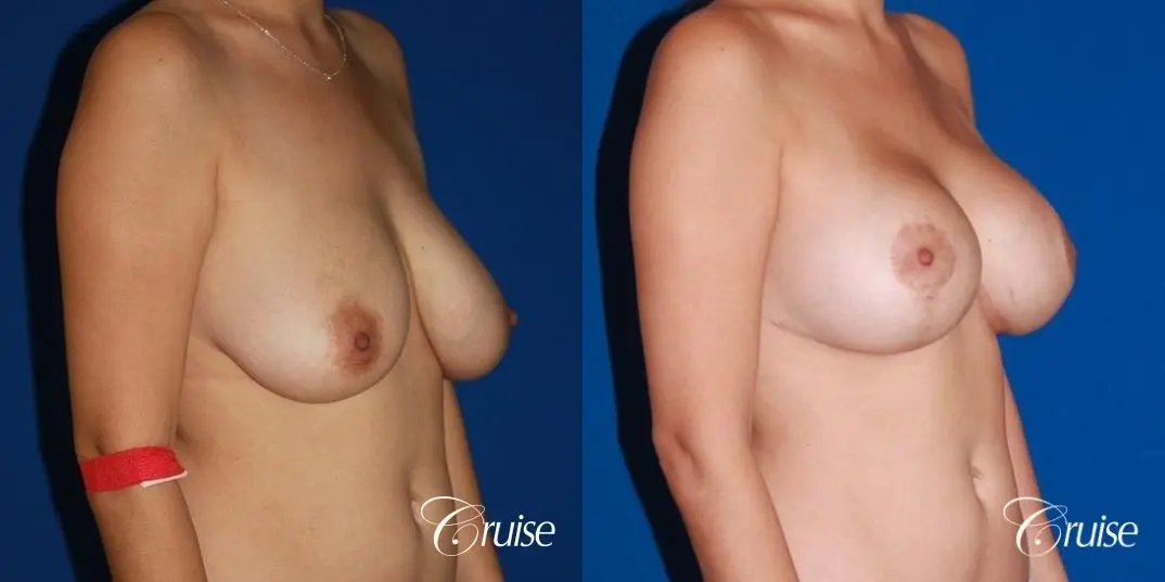 best results for breast lift anchor with saline implanta - Before and After 4