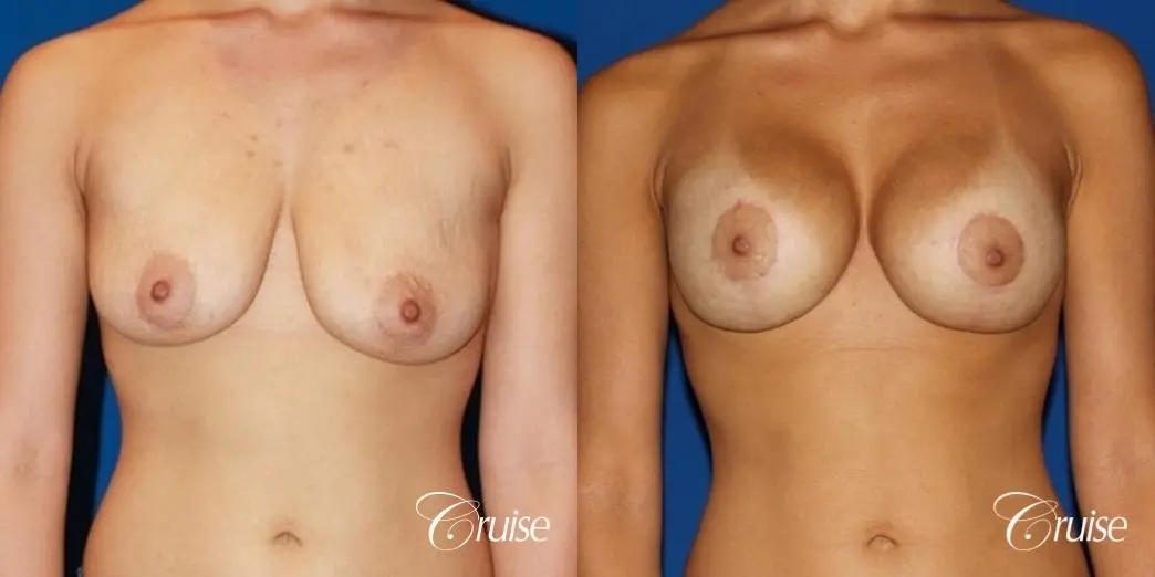 breast lift anchor with saline implants on young girl - Before and After 1