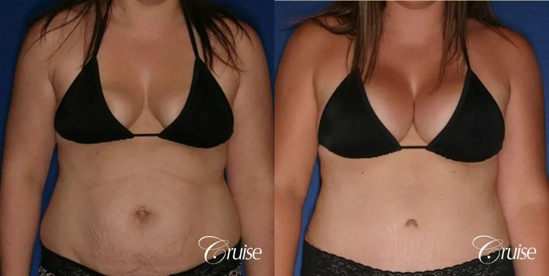 best results on young woman for breast lift anchor with saline augmentation - Before and After 5