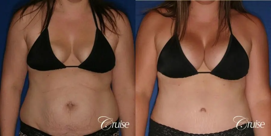 best results on young woman for breast lift anchor with saline augmentation - Before and After 5
