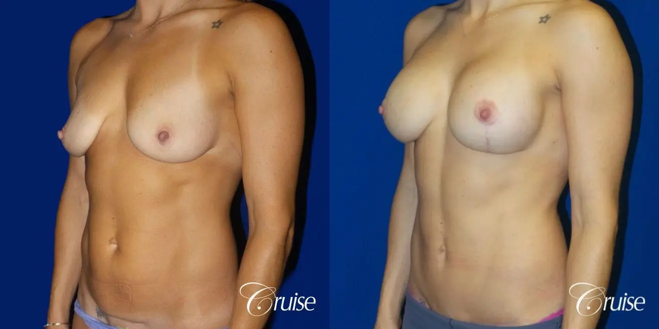 Breast Lift Anchor W/ Silicone Implants On Young Woman - Before and After 3