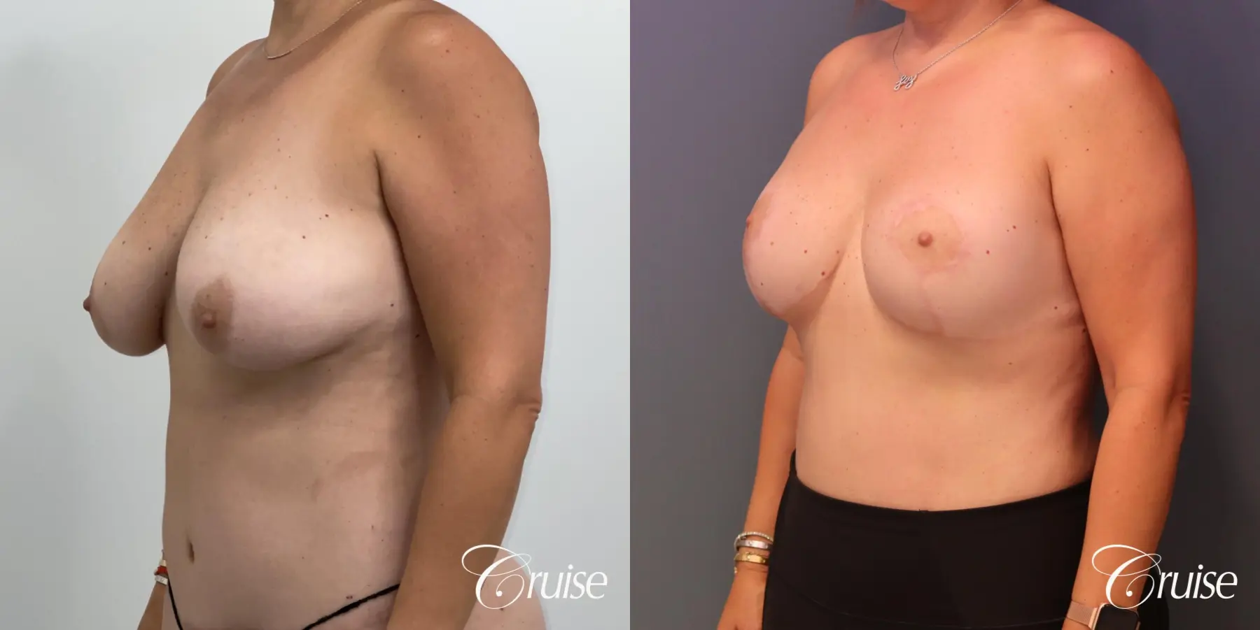 Breast Lift And Augmentation: Patient 74 - Before and After 2