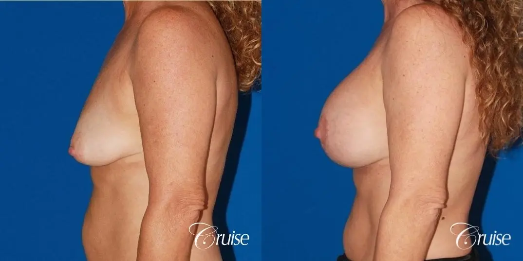 best high profile silicone breast lift 425cc - Before and After 2