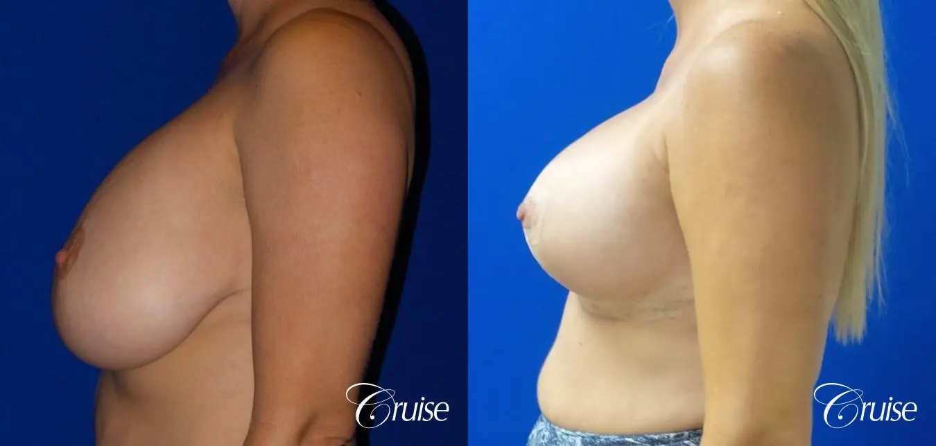 Breast Lift And Augmentation: Patient 12 - Before and After 3