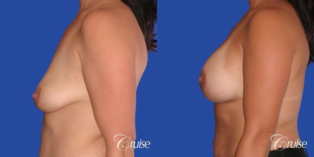 best scars on saline breast lift with top plastic surgeon in Newport Beach - Before and After 2