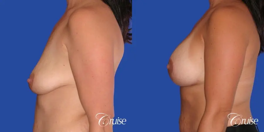 best scars on saline breast lift with top plastic surgeon in Newport Beach - Before and After 2