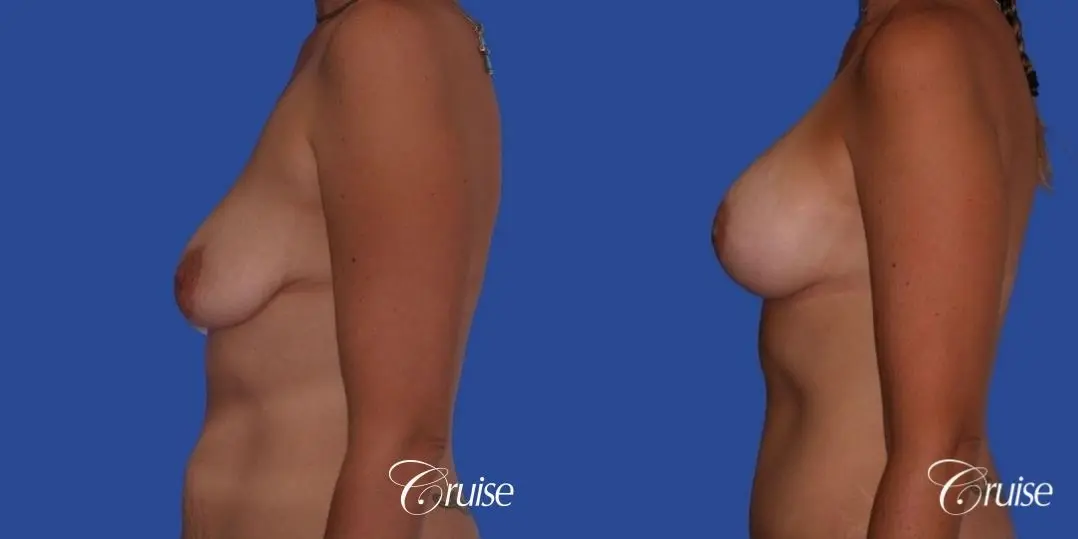 breast lift anchor on young woman - Before and After 2
