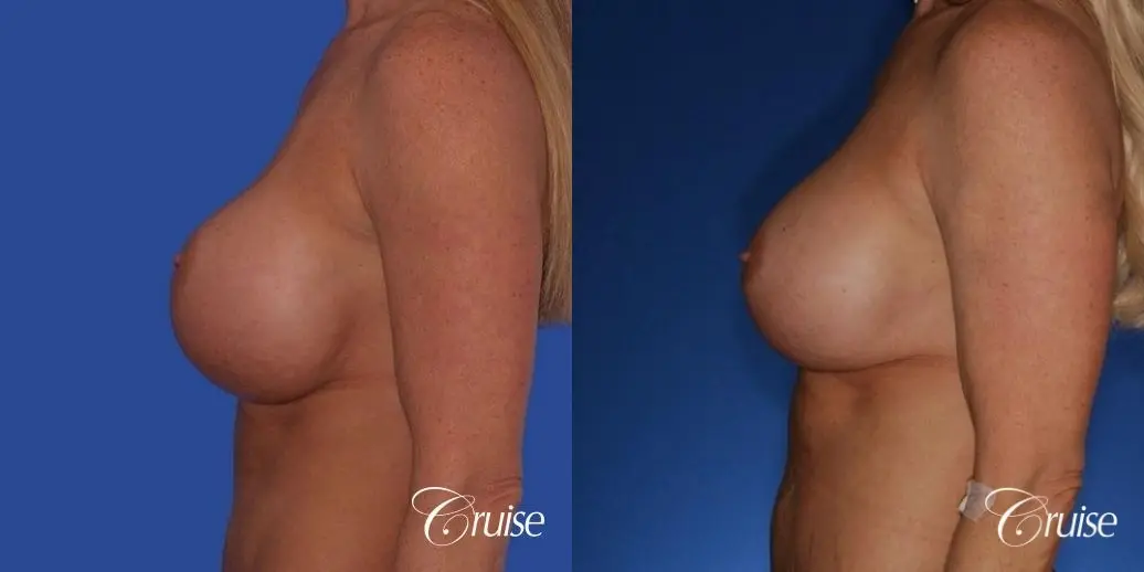 best breast lift anchor photos with HP 475cc implants - Before and After 2