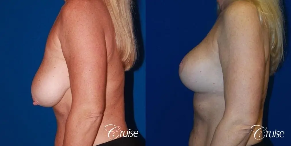 Breast Lift - Saline Augmentation - Before and After 3