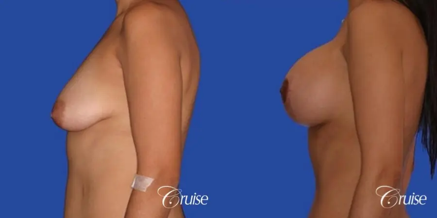 breast lift lollipop before and after - Before and After 2