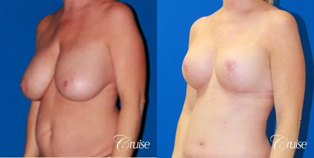 best breast lift revision with saline 270cc - Before and After 3