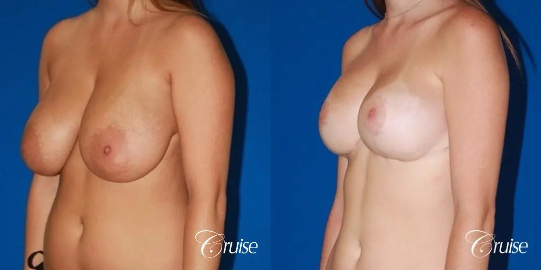 best breast lift and reduction with small saline implants - Before and After 3