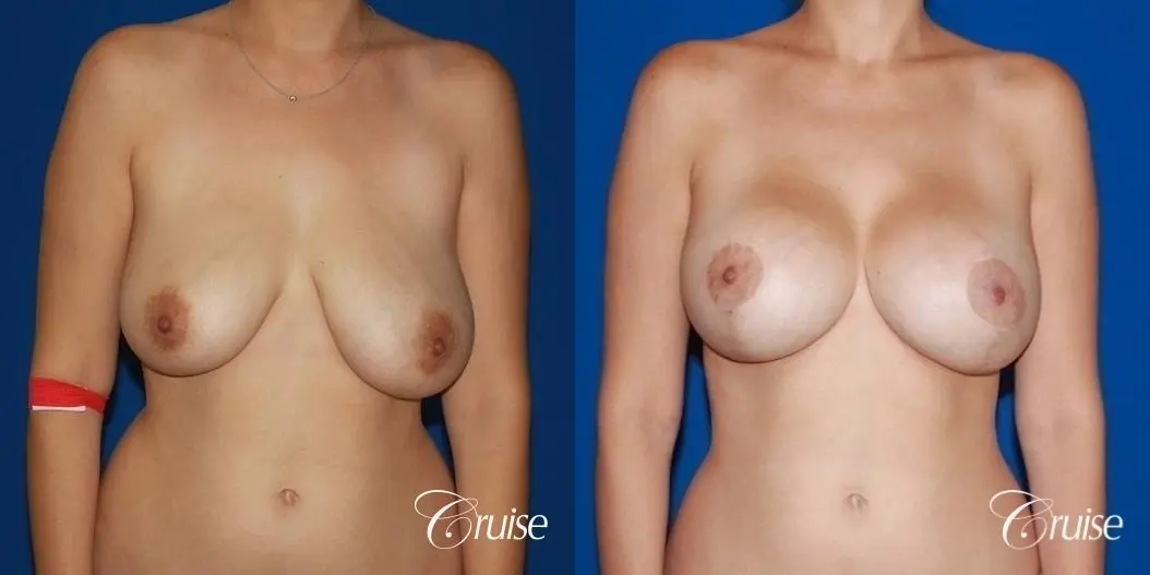 best results for breast lift anchor with saline implanta - Before and After 1