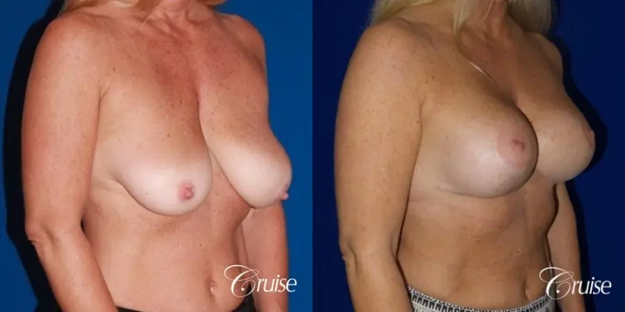 best breast lift with implants - Before and After 4