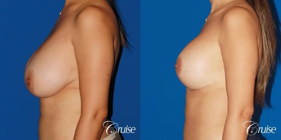 revision breast lift anchor with saline implants - Before and After 2