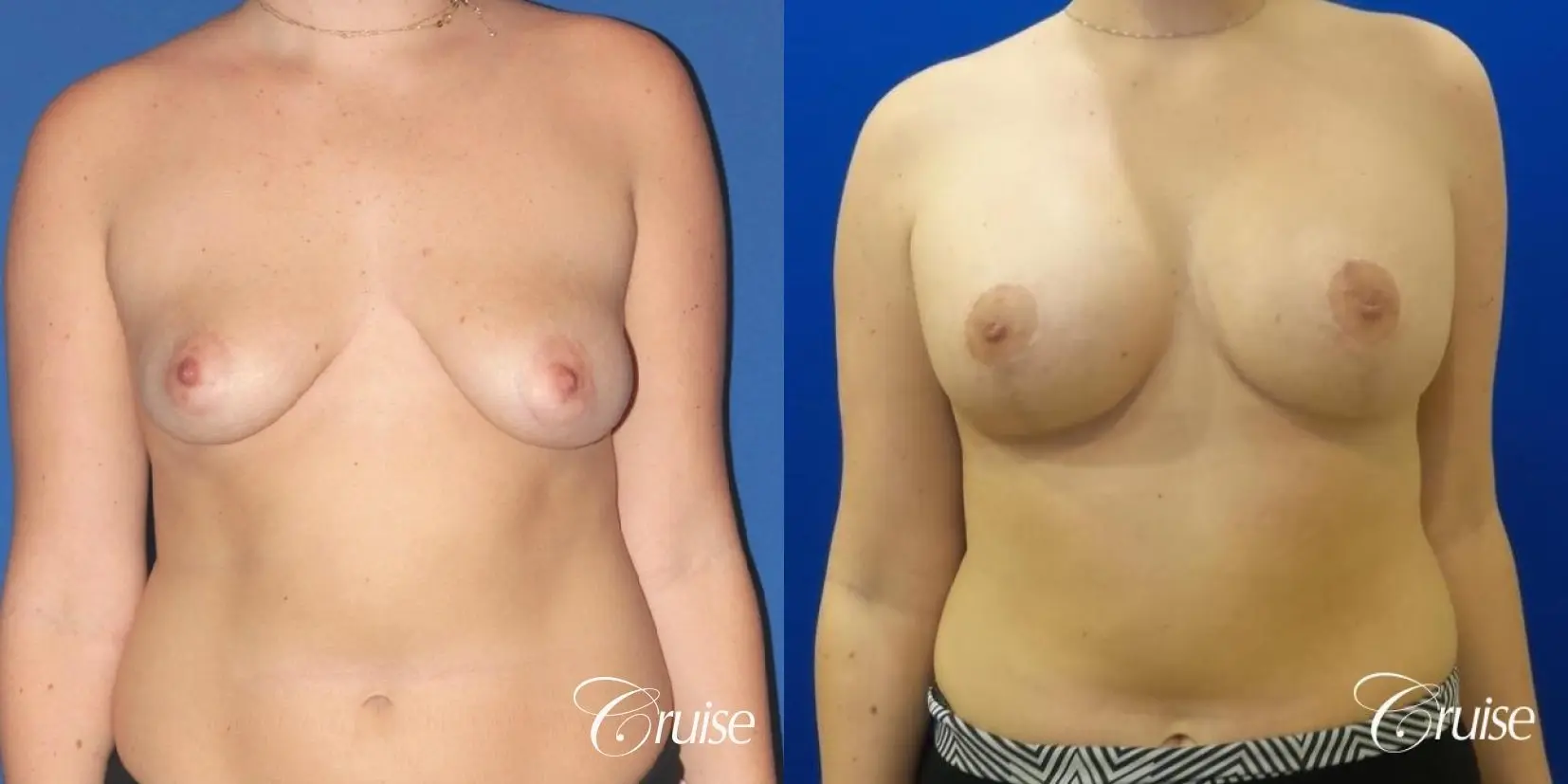 silicone implants with breast lift anchor newport beach - Before and After 1
