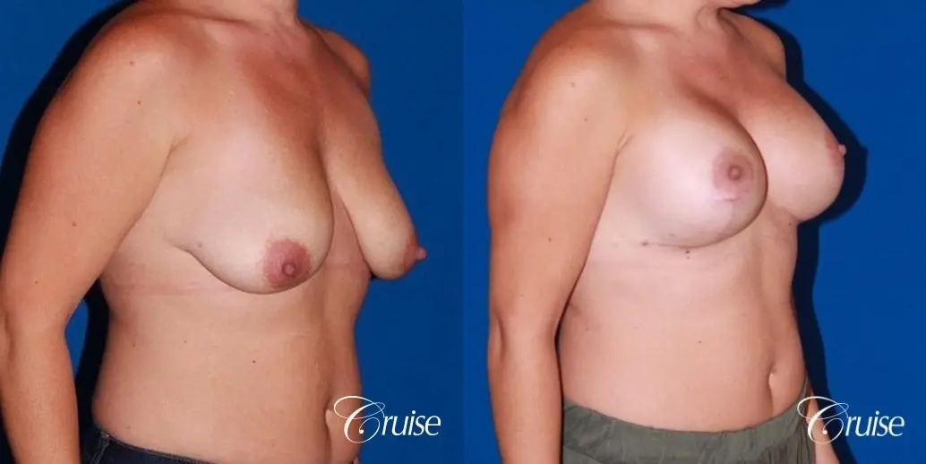 best results for breast lift anchor with saline implants - Before and After 4