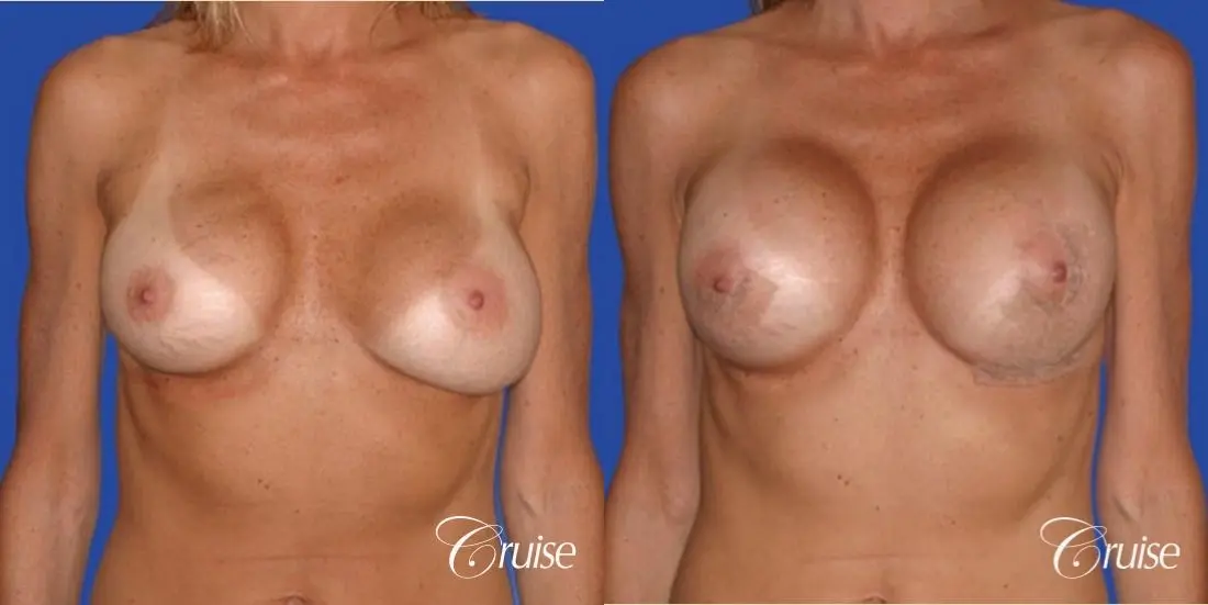 breast lift on one side only before and after pictures - Before and After 1