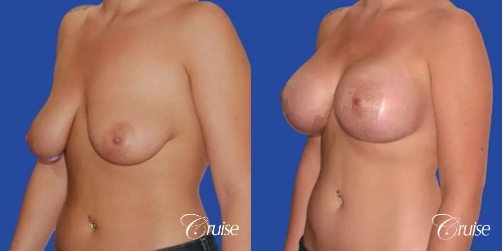 best before and after of silicone breast lift anchor in Newport Beach - Before and After 2
