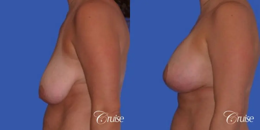 best breast lift anchor results in Orange County on 38 yr old - Before and After 2