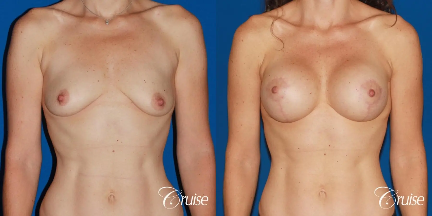 young woman with silicone breast lift anchor - Before and After 1