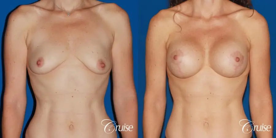 young woman with silicone breast lift anchor - Before and After 1