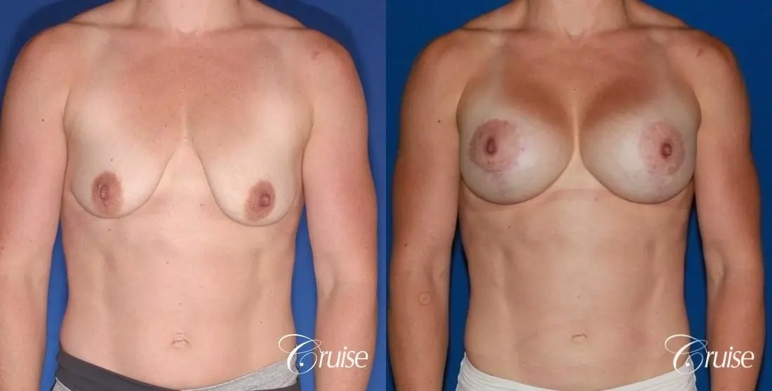 best breast lift anchor on athletic body type - Before and After 1