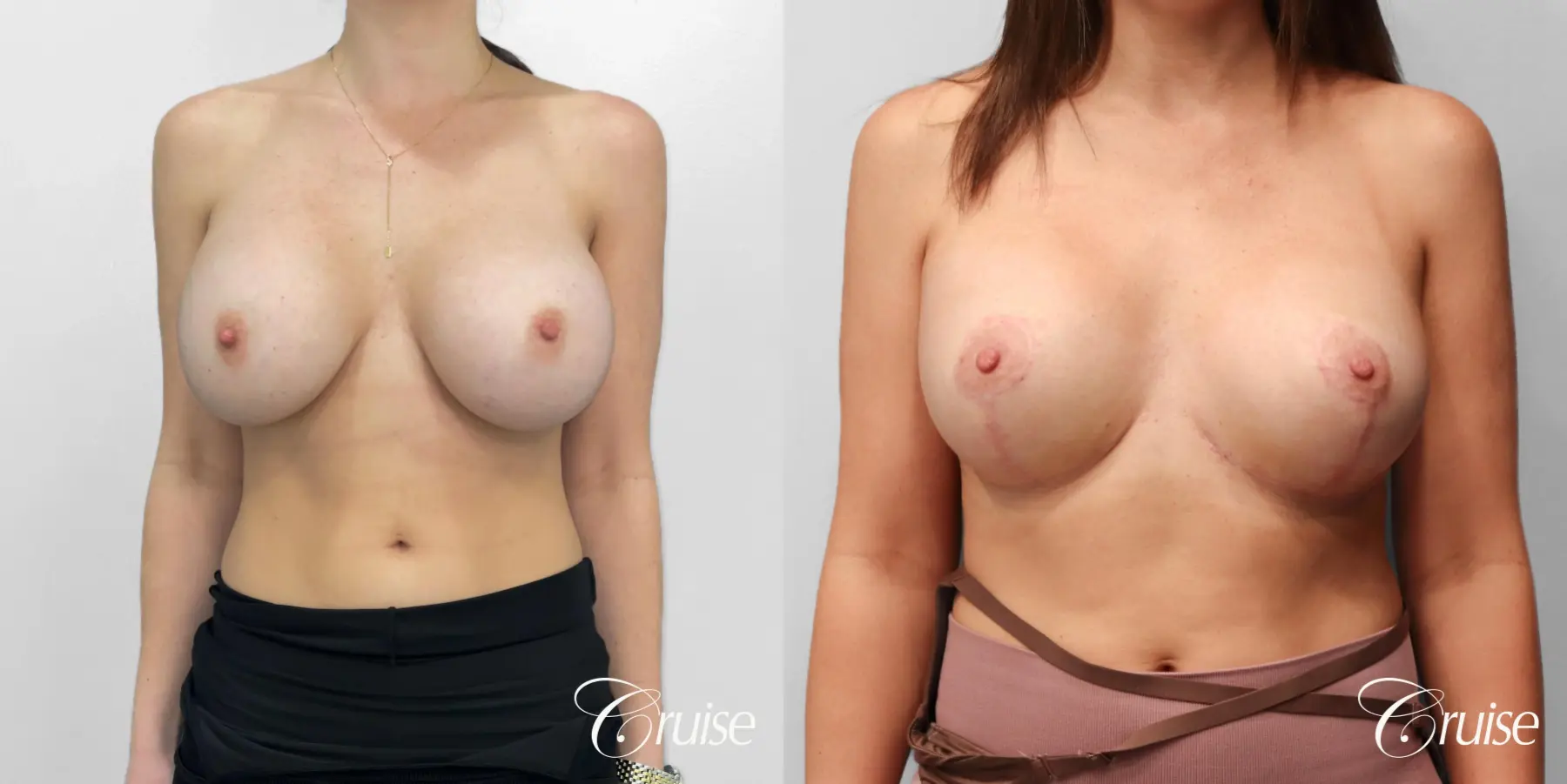 Breast Lift And Augmentation: Patient 75 - Before and After 1
