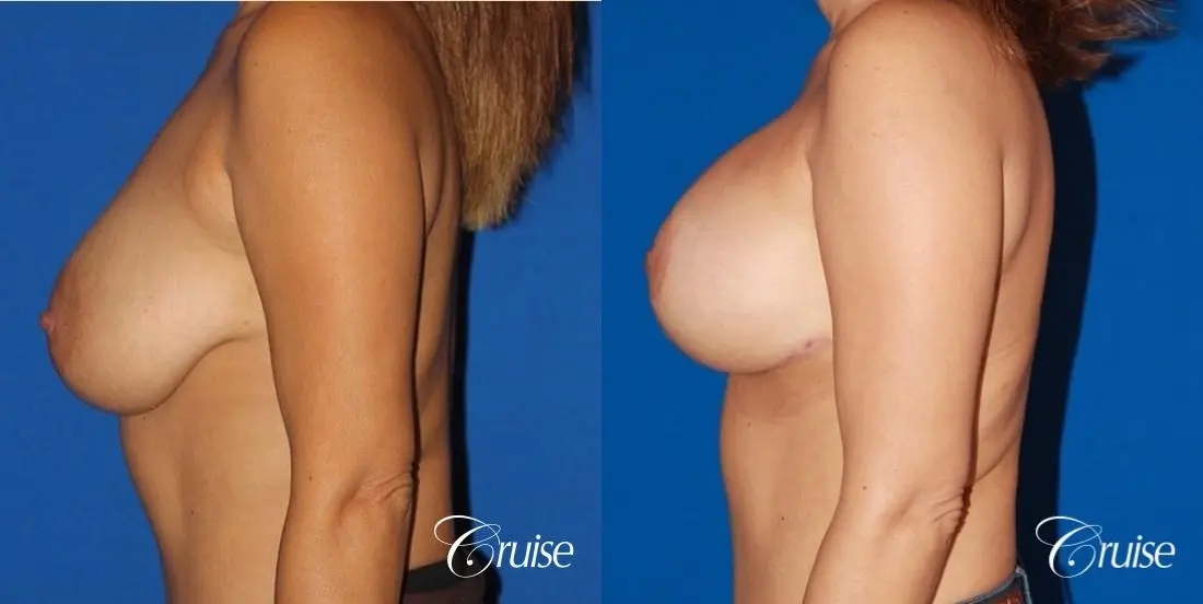 best saline breast lift with 470cc implants - Before and After 2