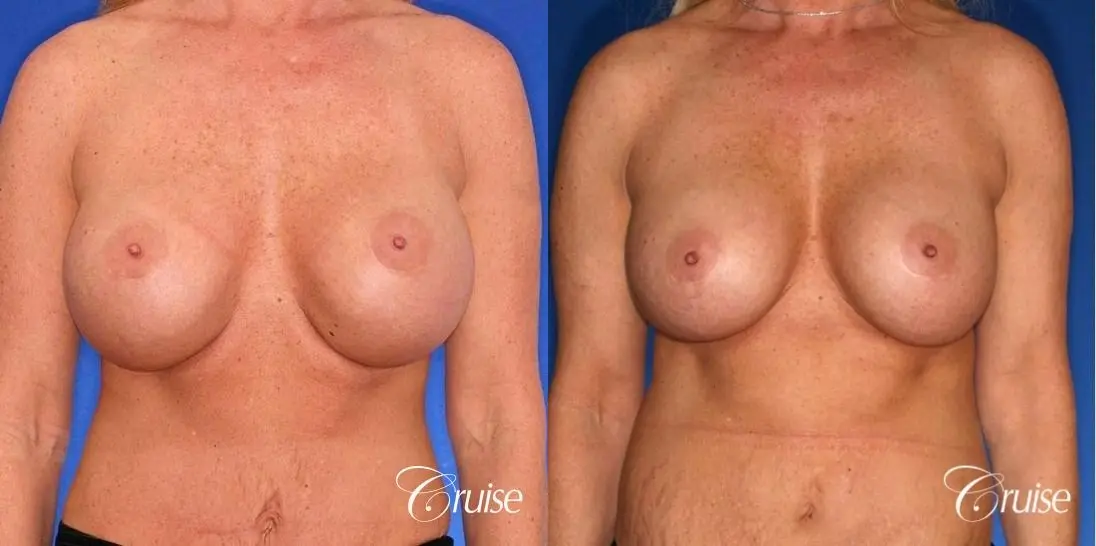 best breast lift anchor photos with HP 475cc implants - Before and After 1