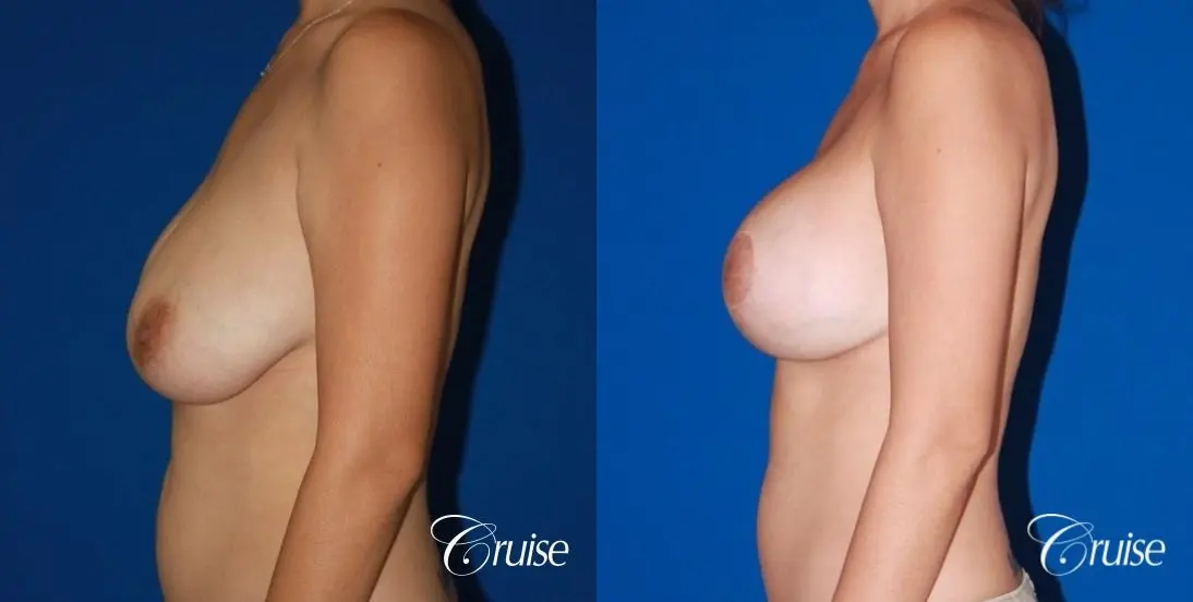 best results for breast lift anchor with saline implanta - Before and After 2