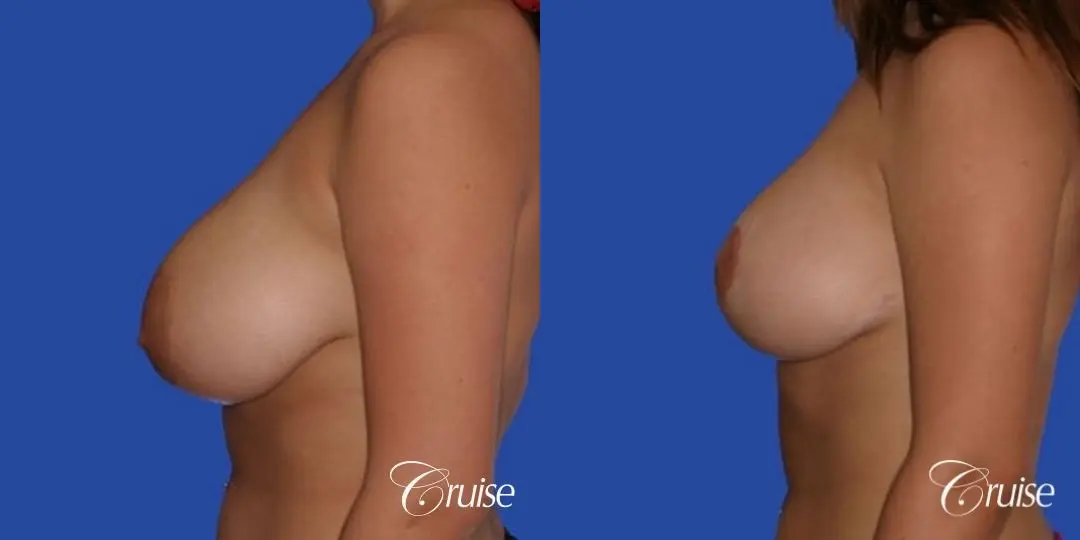 best breast lift on teenager - Before and After 2