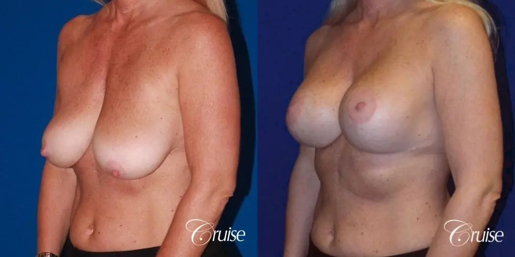 best breast lift with implants - Before and After 2