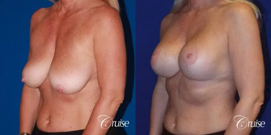 best breast lift with implants - Before and After 2