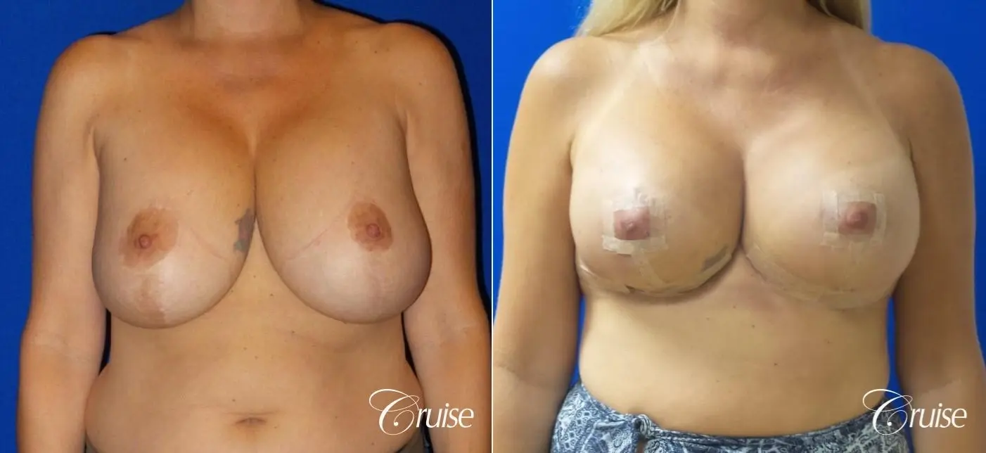 Breast Lift And Augmentation: Patient 6 - Before and After  