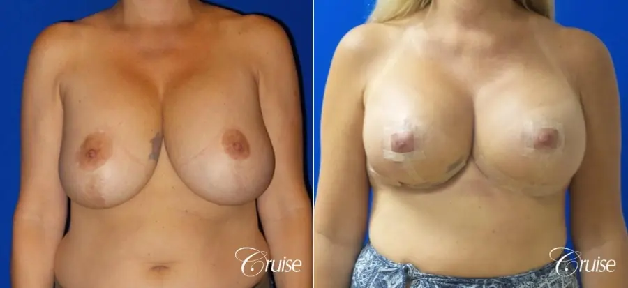 Breast Lift And Augmentation: Patient 6 - Before and After  