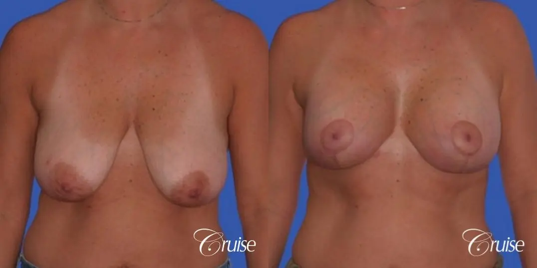 best breast lift anchor results in Orange County on 38 yr old - Before and After 1