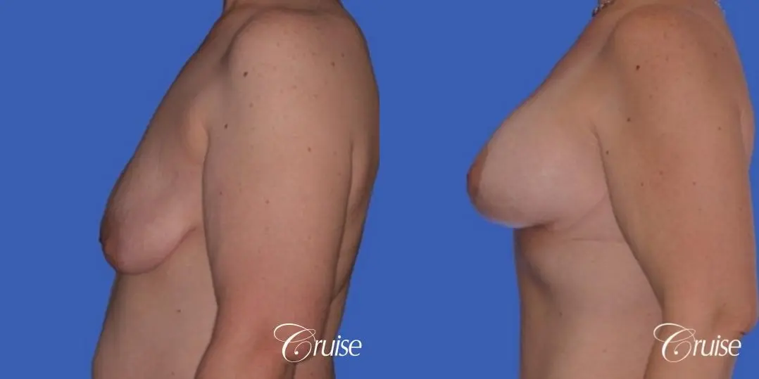 best photos of breast lift anchor on 39 yr old - Before and After 2