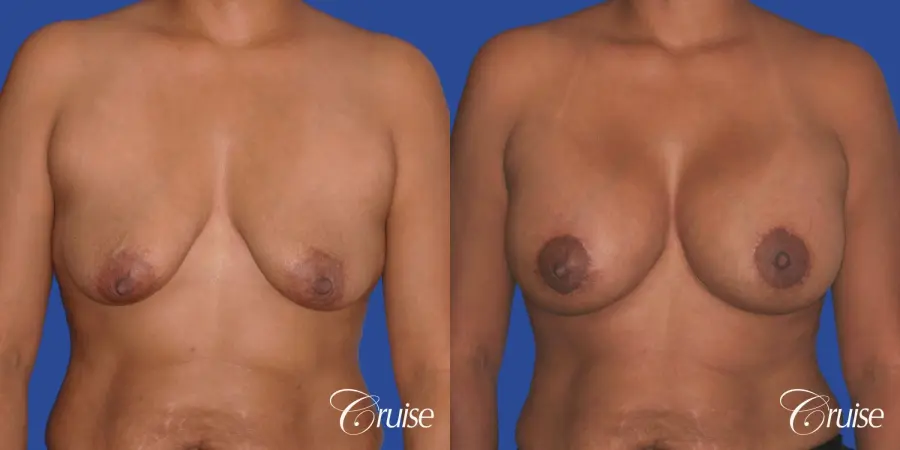 best breast lift donut with saline augmentation - Before and After 1