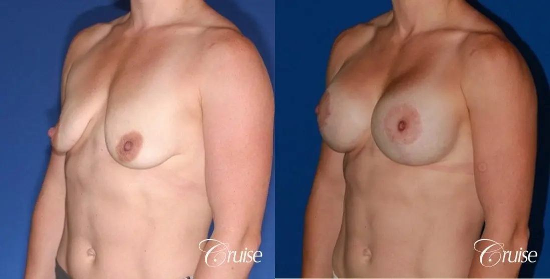 best breast lift anchor on athletic body type - Before and After 2
