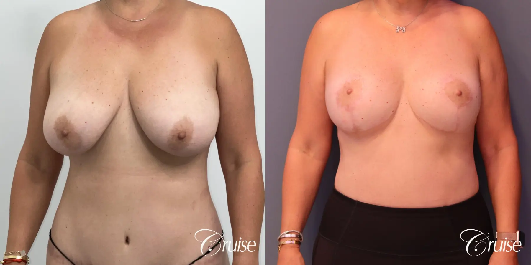 Breast Lift And Augmentation: Patient 76 - Before and After 1