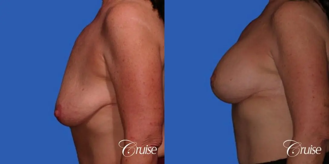 best breast lift anchor with saline augmentation - Before and After 2