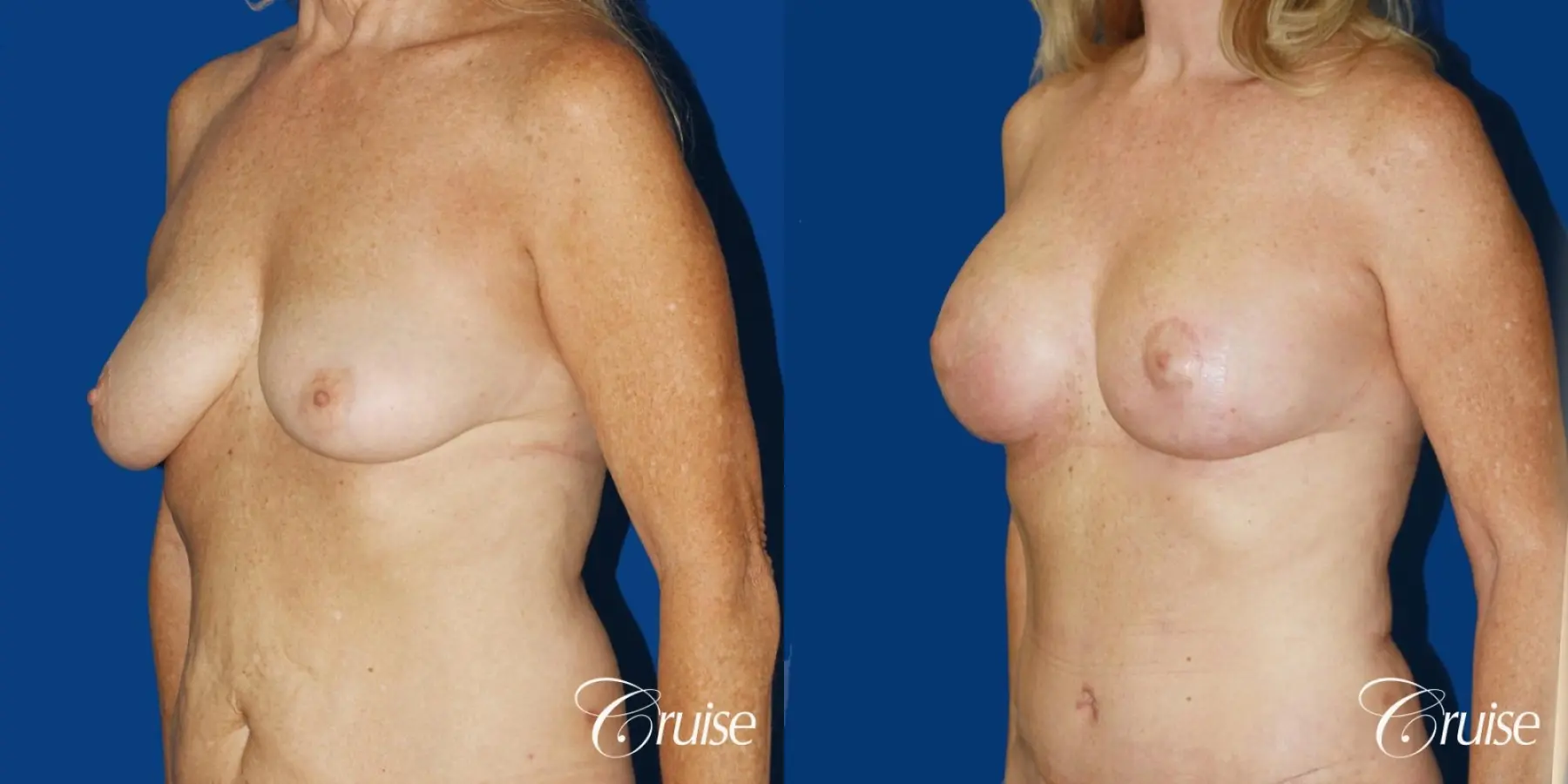62 yr old woman with breast lift anchor and silicone implants - Before and After 3