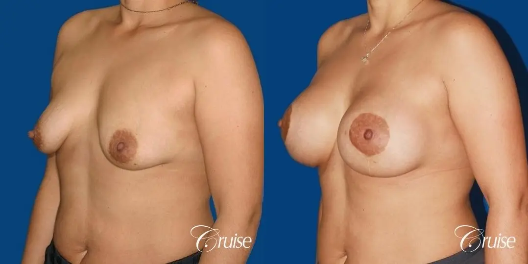 best before and after photos of young breast lift anchor scars - Before and After 3