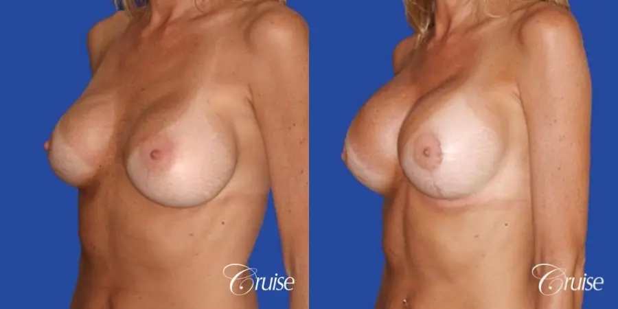 breast lift on one side only before and after pictures - Before and After 3